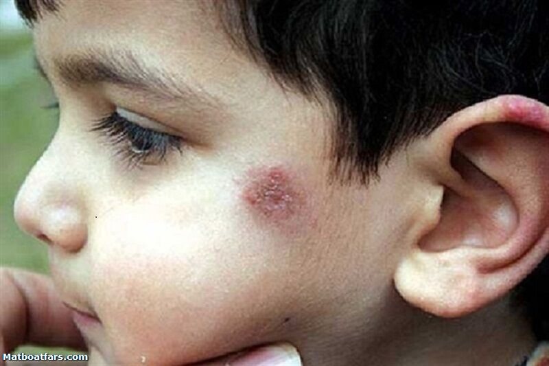 بیماری سالک مرطوب در شهرستان جهرم فارس شایع شده است